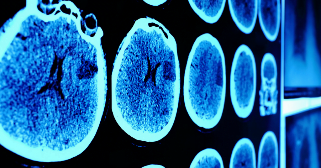 Cancer: Using 3-d to test personalised remedies in 5 days 1