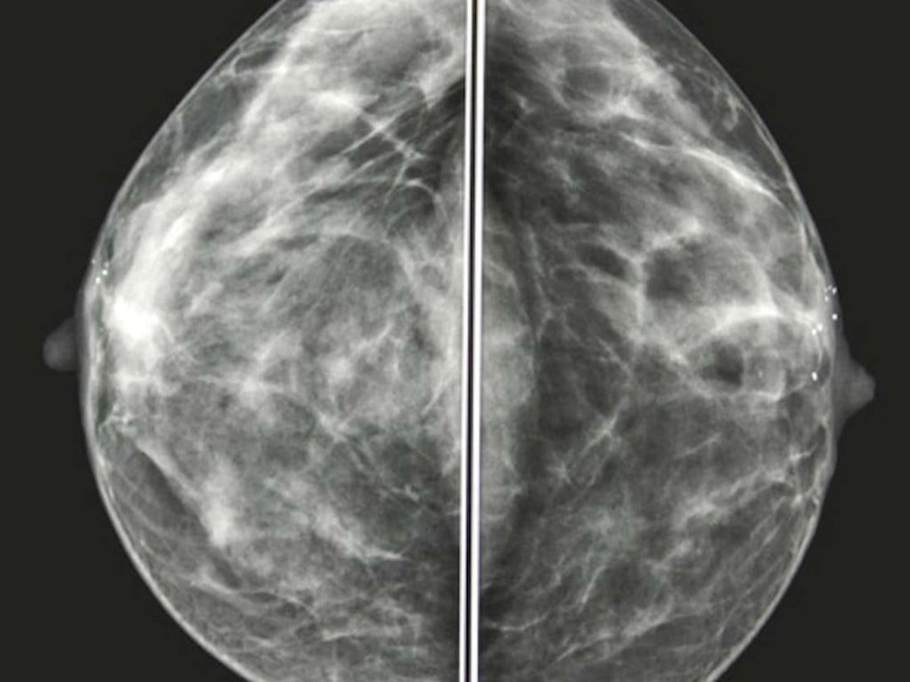 Helping Breast Cancer Survivors Afford Reconstruction 9