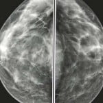 Helping Breast Cancer Survivors Afford Reconstruction 2