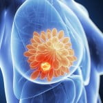 Merck’s Keytruda fails triple terrible breast cancer pivotal study 3