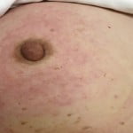 Soy-wealthy food decreases risks of bone fractures in breast cancer survivors 2