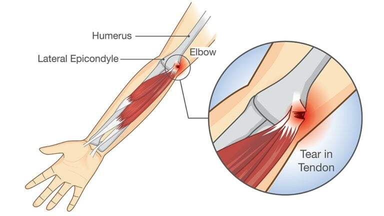 Tennis Elbow Surgery: Tips for a Quick Recovery 4