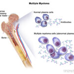 Multiple Myeloma Stages (and How They Differ) 1