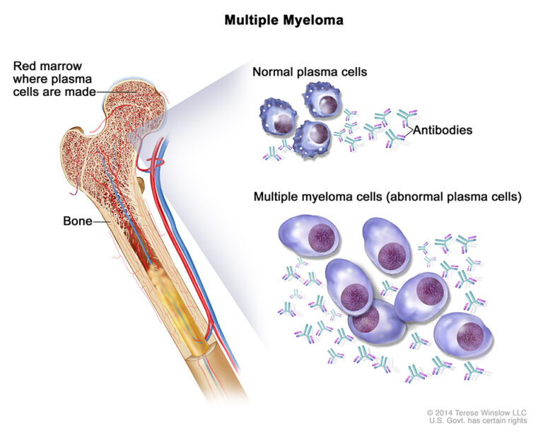 Multiple Myeloma Stages (and How They Differ) 1