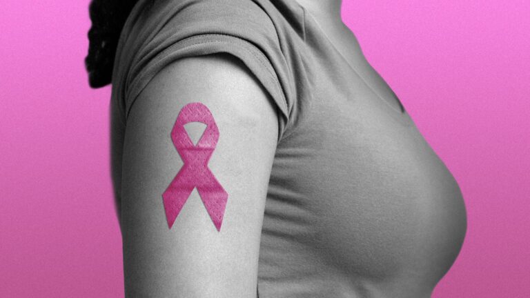 Breast Cancer Mammography Images 6