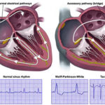 Wolf Parkinsons White Syndrome Treatment 2