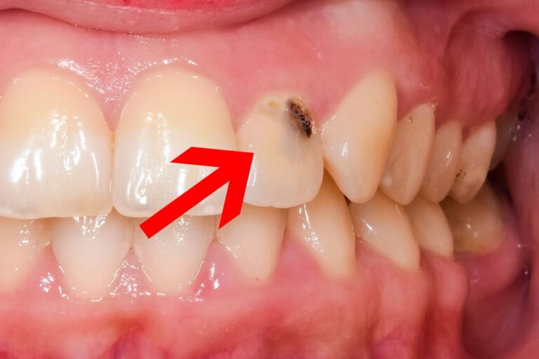 Cavity Between Teeth - What You Should Know About Cavities 7