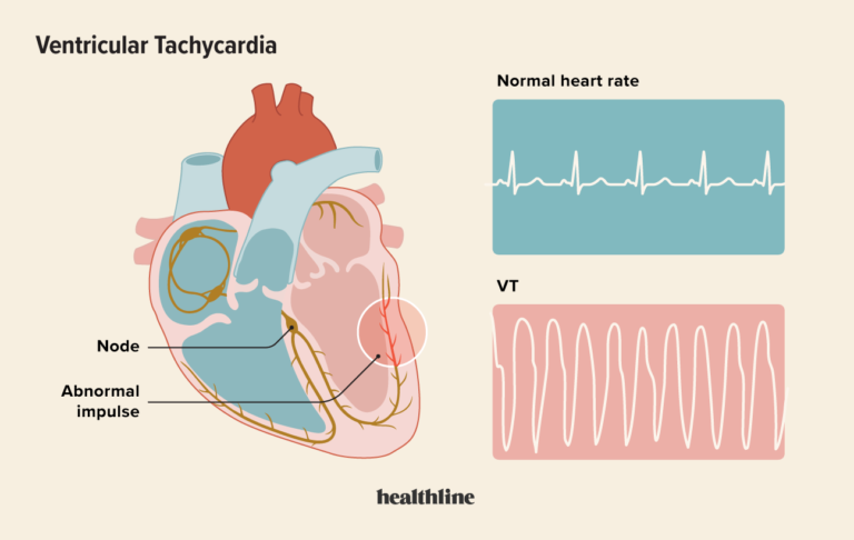 Paroxysmal Atrial Tachycardia - How it Happens 2