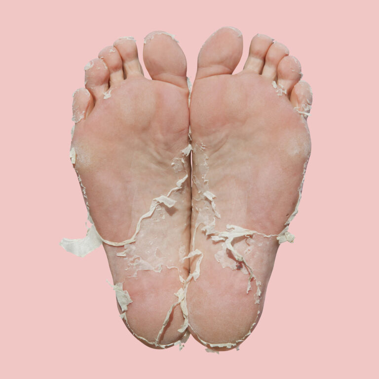 Say Goodbye to Dry, Cracked Feet with a Foot Peel 6